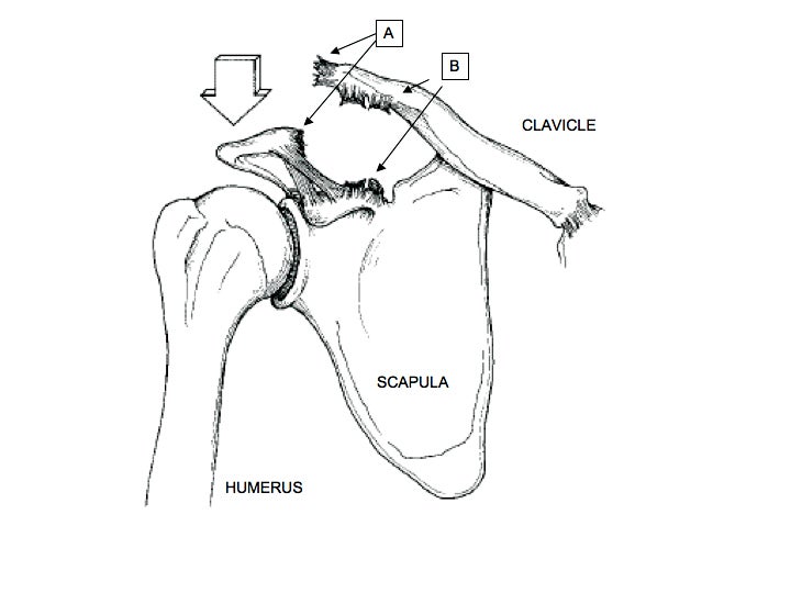 FIGURE 1: Shoulder separations occur when a downward force (ARROW) disrupts the normal ligaments (A & B) connecting the clavicle and scapula. Photo courtesy Dr. Meininger